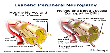 Diabetic Peripheral Neuropathy